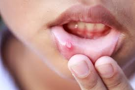 A person showing lip with Oral Mucositis Symptoms