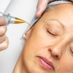 Macro close up detail of laser plasma pen removing facial wart on middle aged woman.