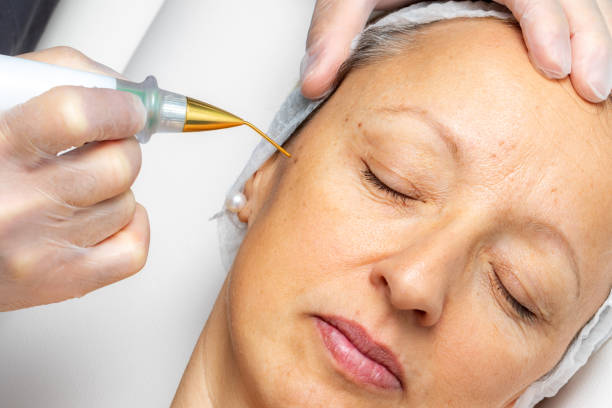 Macro close up detail of laser plasma pen removing facial wart on middle aged woman.