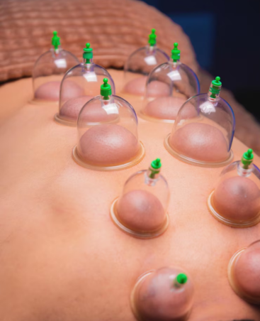 Cupping