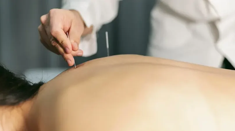 Acupuncture Acupuncture