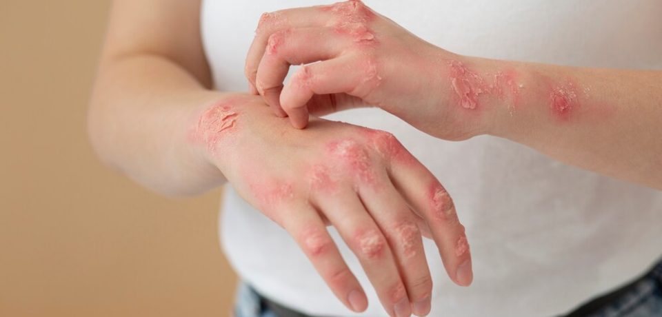 hands-patient-suffering-from-psoriasis_23-2149322109
